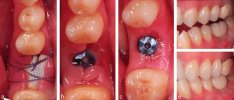 Dental-Implant-Healing-Stages-ezgif.com-webp-to-jpg-converter.jpg