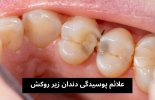 علائم پوسیدگی دندان زیر روکش.jpg