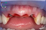 implant2teeth5.jpg