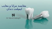 مقایسه مزایا و معایب ایمپلنت دندان.jpg