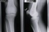 X-ray-knees.jpg