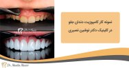 تصویر-نصیری3.jpg--نمونه-کار-کامپوزیت-دندان-جلو.jpg