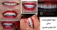 نمونه-کارهای-لمینت-دندان-دکتر-نصیری.jpg