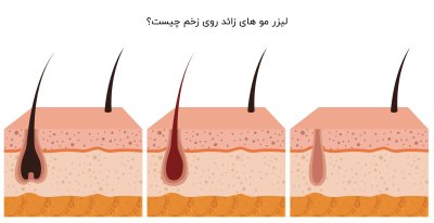 لیزر مو های زائد روی زخم چیست؟ همه چیز در مورد لیزر مو